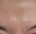 ボトックス（眉間） / ボトックス（目尻） / ボトックス（額） DMTC美容皮膚科 大宮院 DAY 22 サムネイル用