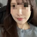 バッカルファット除去 / 脂肪吸引（顔） First Clinic DAY 17 サムネイル用