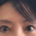 眉下切開 MOMO CLINIC DAY 22 サムネイル用