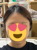 脂肪吸引（顔） / 下まぶたの脂肪取り 東京脂肪吸引クリニック DAY 28 サムネイル用