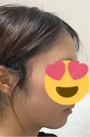 脂肪吸引（顔） / 下まぶたの脂肪取り 東京脂肪吸引クリニック DAY 28 サムネイル用