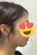 脂肪吸引（顔） / 下まぶたの脂肪取り 東京脂肪吸引クリニック DAY 28 サムネイル用