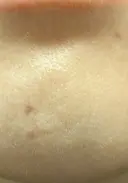 ほくろ・いぼ除去レーザー（肌） プライベートスキンクリニック 梅田本院 AFTER サムネイル用