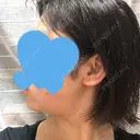 脂肪吸引（顔） GRACIA clinic 【グラシアクリニック】 DAY 23 サムネイル用