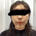 ピーリング（ニキビ・毛穴） / ルメッカ 大美会クリニック 梅田院 DAY 0 サムネイル用