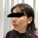 ピーリング（ニキビ・毛穴） / ルメッカ 大美会クリニック 梅田院 DAY 0 サムネイル用