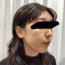 ピーリング（ニキビ・毛穴） / ルメッカ 大美会クリニック 梅田院 DAY 0 サムネイル用