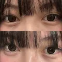 ヒアルロン酸注入（涙袋） / ヒアルロン酸注入（唇） HAAB BEAUTY CLINIC 南青山本院（新院） DAY 0 サムネイル用