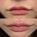 ヒアルロン酸注入（涙袋） / ヒアルロン酸注入（唇） HAAB BEAUTY CLINIC 南青山本院（新院） DAY 0 サムネイル用