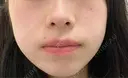 ほくろ・いぼ除去レーザー（肌） ルラ美容クリニック 大宮院 / ルラスキンクリニック 大宮院 DAY 0 サムネイル用