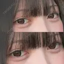 ヒアルロン酸注入（涙袋） / ヒアルロン酸注入（唇） HAAB BEAUTY CLINIC 南青山本院（新院） AFTER サムネイル用