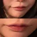 ヒアルロン酸注入（涙袋） / ヒアルロン酸注入（唇） HAAB BEAUTY CLINIC 南青山本院（新院） DAY 3 サムネイル用