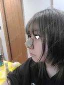 鼻尖形成（切開） / 鼻中隔延長（切開） / 小鼻縮小（切開） / 軟骨移植 / 骨切幅寄せ / 鼻柱下降・鼻唇角形成（猫手術） WOM CLINIC GINZA （ワム クリニック ギンザ） DAY 12 サムネイル用