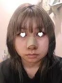 鼻尖形成（切開） / 鼻中隔延長（切開） / 小鼻縮小（切開） / 軟骨移植 / 骨切幅寄せ / 鼻柱下降・鼻唇角形成（猫手術） WOM CLINIC GINZA （ワム クリニック ギンザ） DAY 12 サムネイル用