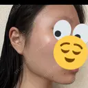 糸リフト / 脂肪吸引（顔） EMMA CLINIC（エマクリニック） DAY 32 サムネイル用