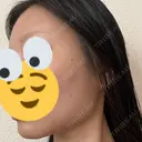 糸リフト / 脂肪吸引（顔） EMMA CLINIC（エマクリニック） DAY 32 サムネイル用