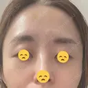 ボトックス（あご） / ボトックス（口角） / ボトックス（眉間） / ボトックス（額） / ボトックス（バニーライン） / その他（鼻） TCB東京中央美容外科 札幌駅前院 DAY 5 サムネイル用