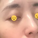 ボトックス（あご） / ボトックス（口角） / ボトックス（眉間） / ボトックス（額） / ボトックス（バニーライン） / その他（鼻） TCB東京中央美容外科 札幌駅前院 DAY 5 サムネイル用