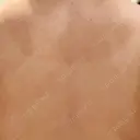 ピコフラクショナルレーザー（毛穴・ニキビ跡） ルラ美容クリニック 広島院 DAY 11 サムネイル用