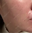 エレクトロポレーション / 毛穴洗浄（ハイドラフェイシャルなど） / ニードルRF（ポテンツァなど） クレオビューティークリニック AFTER サムネイル用