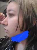 鼻尖形成（切開） / 鼻中隔延長（切開） / 小鼻縮小（切開） / 軟骨移植 / 骨切幅寄せ / 鼻柱下降・鼻唇角形成（猫手術） WOM CLINIC GINZA （ワム クリニック ギンザ） DAY 14 サムネイル用