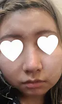 鼻尖形成（切開） / 鼻中隔延長（切開） / 小鼻縮小（切開） / 軟骨移植 / 骨切幅寄せ / 鼻柱下降・鼻唇角形成（猫手術） WOM CLINIC GINZA （ワム クリニック ギンザ） DAY 14 サムネイル用