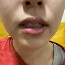 ハイフ（顔） 共立美容外科 大阪本院 DAY 10 サムネイル用