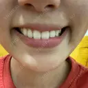 ハイフ（顔） 共立美容外科 大阪本院 DAY 12 サムネイル用