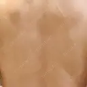 ピコフラクショナルレーザー（毛穴・ニキビ跡） ルラ美容クリニック 広島院 DAY 12 サムネイル用