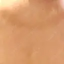 ピコフラクショナルレーザー（毛穴・ニキビ跡） ルラ美容クリニック 広島院 AFTER サムネイル用