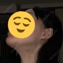 脂肪吸引（顔） / ネックリフト リラ・クラニオフェイシャル・クリニック DAY 32 サムネイル用