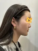 糸リフト / バッカルファット除去 / 脂肪吸引（顔） / 額を丸く / 脂肪吸引（脚） / 脂肪注入（額） / メーラーファット除去 / 脂肪注入（輪郭） First Clinic DAY 16 サムネイル用