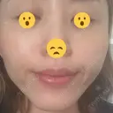 ボトックス（あご） / ボトックス（口角） / ボトックス（眉間） / ボトックス（額） / ボトックス（バニーライン） / その他（鼻） TCB東京中央美容外科 札幌駅前院 DAY 7 サムネイル用