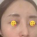 ボトックス（あご） / ボトックス（口角） / ボトックス（眉間） / ボトックス（額） / ボトックス（バニーライン） / その他（鼻） TCB東京中央美容外科 札幌駅前院 DAY 7 サムネイル用