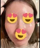 フラクショナルレーザー（毛穴・ニキビ跡） おおかみ美容のクリニック 新宿院 AFTER サムネイル用