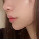 ボトックス（あご） / ヒアルロン酸注入（あご） HAAB BEAUTY CLINIC 名古屋院 AFTER サムネイル用