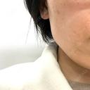 光治療（フォトフェイシャルなど） 銀座TSUBAKIクリニック AFTER サムネイル用