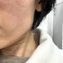 光治療（フォトフェイシャルなど） 銀座TSUBAKIクリニック DAY 6 サムネイル用