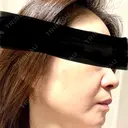 ルメッカ 東京シルククリニック 東京神田院 AFTER サムネイル用