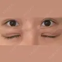 二重切開 / 眼瞼下垂（切開） / 上まぶたたるみ取り eクリニック 福岡院 DAY 18 サムネイル用