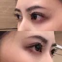 二重切開 ルネッサンス美容外科医院 神戸院 DAY 106 サムネイル用