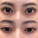 二重切開 ルネッサンス美容外科医院 神戸院 DAY 106 サムネイル用