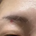 ほくろ・いぼ除去レーザー（肌） Fellez Clinic【フェルズクリニック】 DAY 7 サムネイル用