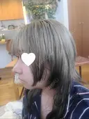 鼻尖形成（切開） / 鼻中隔延長（切開） / 小鼻縮小（切開） / 軟骨移植 / 骨切幅寄せ / 鼻柱下降・鼻唇角形成（猫手術） WOM CLINIC GINZA （ワム クリニック ギンザ） DAY 17 サムネイル用