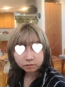 鼻尖形成（切開） / 鼻中隔延長（切開） / 小鼻縮小（切開） / 軟骨移植 / 骨切幅寄せ / 鼻柱下降・鼻唇角形成（猫手術） WOM CLINIC GINZA （ワム クリニック ギンザ） DAY 17 サムネイル用