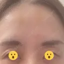 ボトックス（あご） / ボトックス（口角） / ボトックス（眉間） / ボトックス（額） / ボトックス（バニーライン） / その他（鼻） TCB東京中央美容外科 札幌駅前院 DAY 9 サムネイル用