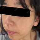 ピーリング（ニキビ・毛穴） / ルメッカ 大美会クリニック 梅田院 DAY 6 サムネイル用