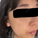 ピーリング（ニキビ・毛穴） / ルメッカ 大美会クリニック 梅田院 DAY 6 サムネイル用