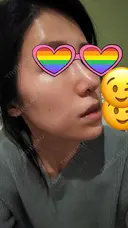 鼻尖形成（切開） / 軟骨移植 表参道スキンクリニック 表参道院 DAY 7 サムネイル用