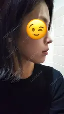 鼻尖形成（切開） / 軟骨移植 表参道スキンクリニック 表参道院 DAY 26 サムネイル用